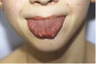 NEJM：多发性舌黏膜神经瘤