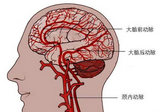 Neurology：HIV患者脑动脉重塑对其<font color="red">非</font>栓塞<font color="red">性</font>脑梗死的作用