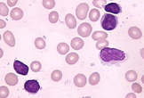 Blood：毛细胞白血病中的新突变
