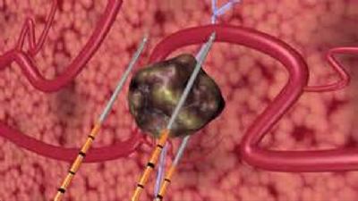 Ann Surg：不可逆电穿孔技术或可有效延长胰腺癌患者的生存率