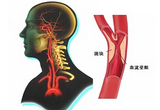 Circulation：缺血性脑卒中患者外周动脉事件发生率、危险因素及预后