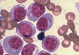 Lancet Oncol：Ofatumumab维持治疗<font color="red">慢性</font>淋巴<font color="red">细胞</font><font color="red">白血病</font>效果