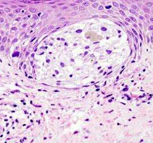 Cell：耐药性黑色素瘤的里程碑式研究