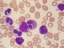 Lancet Oncol：<font color="red">三</font><font color="red">氧化</font><font color="red">二</font><font color="red">砷</font>和ATRA治疗所有危险急性早幼粒细胞白血病人群效果较好