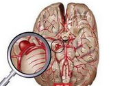 实用：临床上常见脑出血部位快速辨识