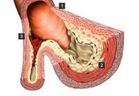 Atherosclerosis：空腹及餐后甘油三酯和颈动脉内膜厚度的关系