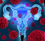 Behav Med：有卵巢癌<font color="red">家族</font><font color="red">史</font>，应同乳腺癌一样警惕卵巢癌！！！