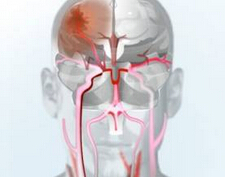 Cerebrovasc Dis: 无症状性实质出血史患者，静脉溶栓后脑内出血的风险未增加
