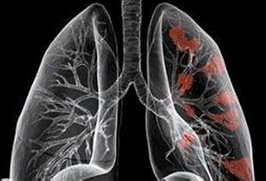 难治性肺鳞状细胞癌患者接受阿法替尼治疗后的生存期优于特罗凯