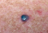 Melanoma Res：皮肤自检对黑色素瘤患者很重要，但很少做到