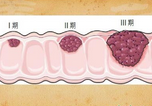 JAMA：直肠癌患者：<font color="red">腹腔</font>镜<font color="red">手术</font>vs开腹<font color="red">手术</font>