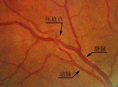 Neurology: <font color="red">视网膜</font><font color="red">静脉</font>阻塞患者更易发生缺血性卒中