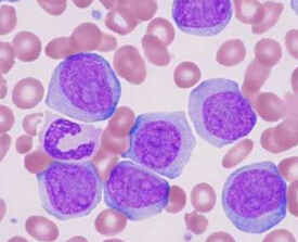 Oncotarget：<font color="red">前列腺</font>癌药物或可用于治疗白血病