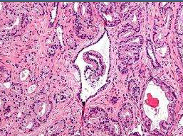PNAS：致死性前列腺癌细胞或具有干细胞样特性
