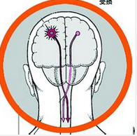 控制卒中后抑郁和<font color="red">降低血压</font>是预防卒中复发的两大关键