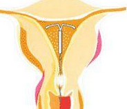 Am J Obstet Gynecol：左炔诺孕酮宫内缓释系统治疗子宫内膜不典型增生较口服孕激素更优