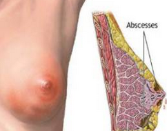 浆细胞乳腺炎易误诊为癌 统一标准亟待制订