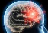 Neurology：这些影像学特征提示SVD患者帕金森<font color="red">风险</font><font color="red">增加</font>
