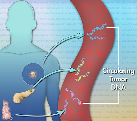 液体活检技术临床应用进展：CTC，ctDNA和外泌体检测