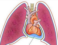 Heart：秋水仙碱对心脏术后的心包积液没有什么用？