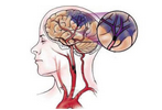 Brain：中风患者右半球灰质体积增加可促进其语言功能的恢复