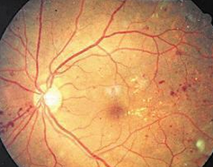 徐国彤：视网膜下腔移植不同干细胞对大鼠视网膜<font color="red">变性</font>的干预作用