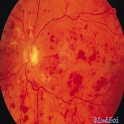 JAMA：增生性糖尿病性视网膜病变治疗有了新选择