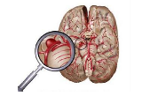 JAMA Neurol：蛛网膜下腔出血后<font color="red">意识</font><font color="red">丧失</font>是早期脑损伤的重要表现