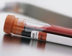 STM：血液<font color="red">检测</font>可预测乳腺癌药物抵抗