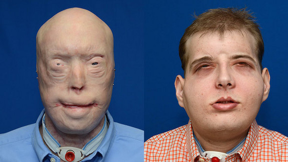 美国医生完成迄今为止最复杂的“变脸”手术