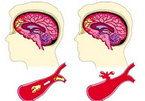NEJM：主动脉生物瓣膜置换后的<font color="red">血栓</font>形成的相关研究