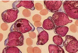 FDA批准Ninlaro（ixazomib）用于治疗<font color="red">多发性</font><font color="red">骨髓瘤</font>（MM），今年共批准三个MM新药