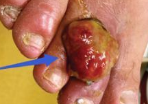 Lancet：艾滋病足趾间罕见似化脓性肉芽肿的卡波氏肉瘤——案例报道