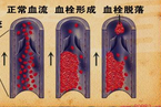 Medicine：亚洲人群COPD患者<font color="red">深</font><font color="red">静脉血栓</font>的发生高于非COPD患者