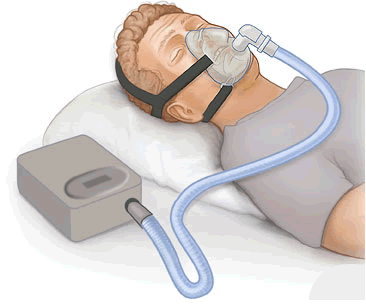 Sleep Med：<font color="red">长期</font>CPAP改善中度-重度OSA高龄患者生存