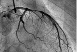 Lancet：对于冠状动脉造影和PCI辐射暴露的担心是多余的