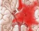 Front Neurol Neurosci：脑<font color="red">出血</font>发生的流行病学