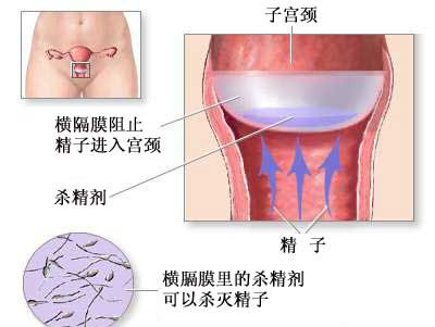 <font color="red">避孕</font>方法-橫隔膜<font color="red">避孕</font>法（圖片）