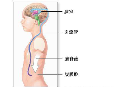 脑室-腹膜分流术-手术过程（<font color="red">图片</font>）