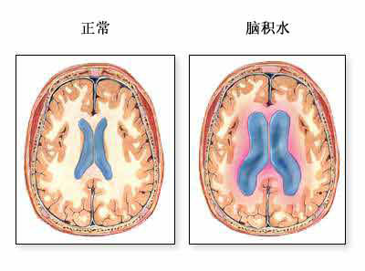 脑室-腹膜<font color="red">分流</font><font color="red">术</font>-手术适应症（图片）