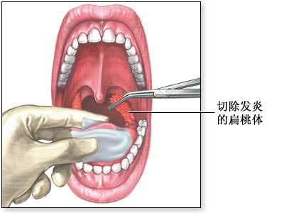 扁桃腺切除术-手术过程（图片）