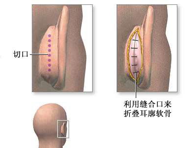耳外科手术-手术过程（图片）