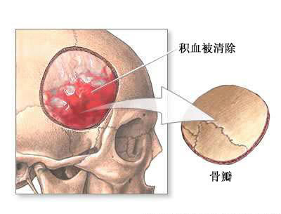 穿颅术-手术过程（图片）