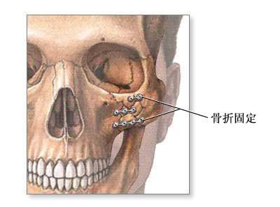 颅面重建术-手术过程（图片）