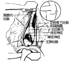 法乐<font color="red">四联</font>症纠治术（图）