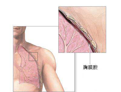胸导管插入术<font color="red">正常</font><font color="red">解剖</font>、手术适应症和手术过程（图片）