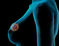 JCO：Oncotype DX乳腺癌检测的种族差异