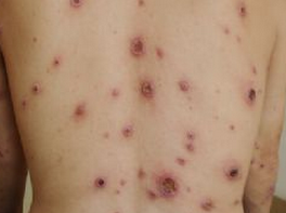 Lancet：恶性梅毒导致皮肤多发溃疡案例报道