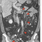 NEJM：结肠憩室炎急性穿孔并发症案例报道