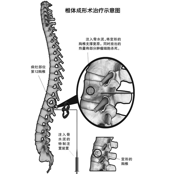 <font color="red">椎</font><font color="red">体</font>成形<font color="red">术</font>治疗示意图